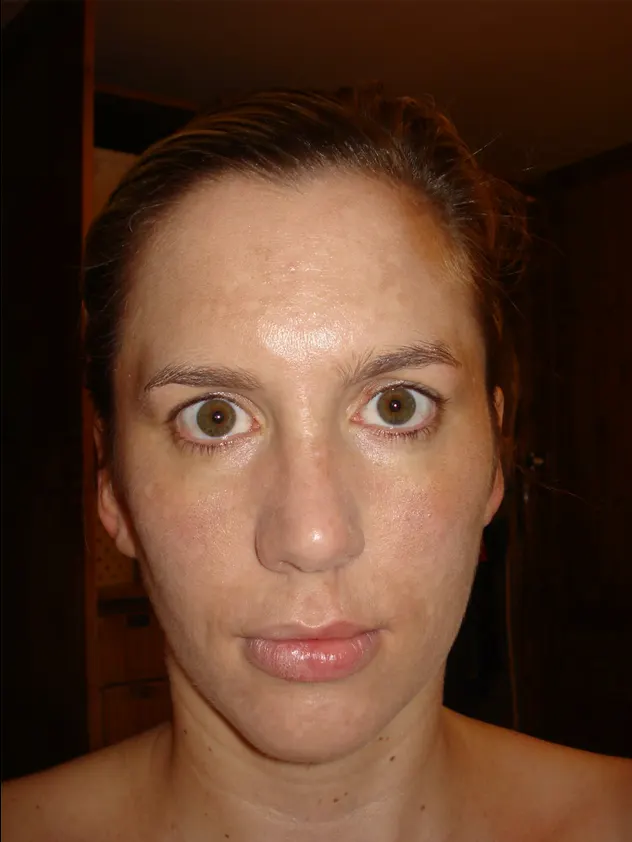 Restylane result 10, after treatment, Dulwich Natural Beauty London