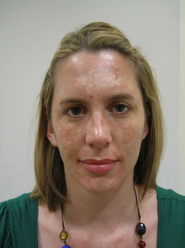 Restylane result 10, before treatment, Dulwich Natural Beauty London