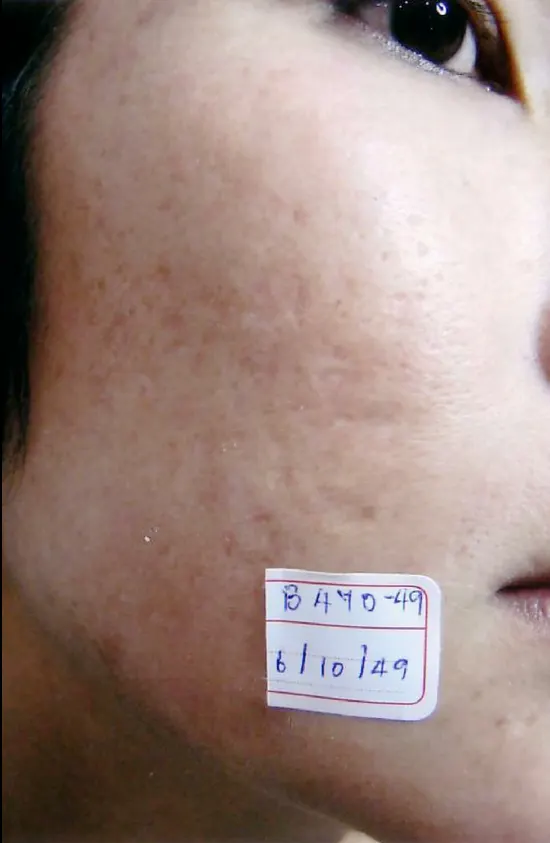 Restylane result 11, after treatment, Dulwich Natural Beauty London