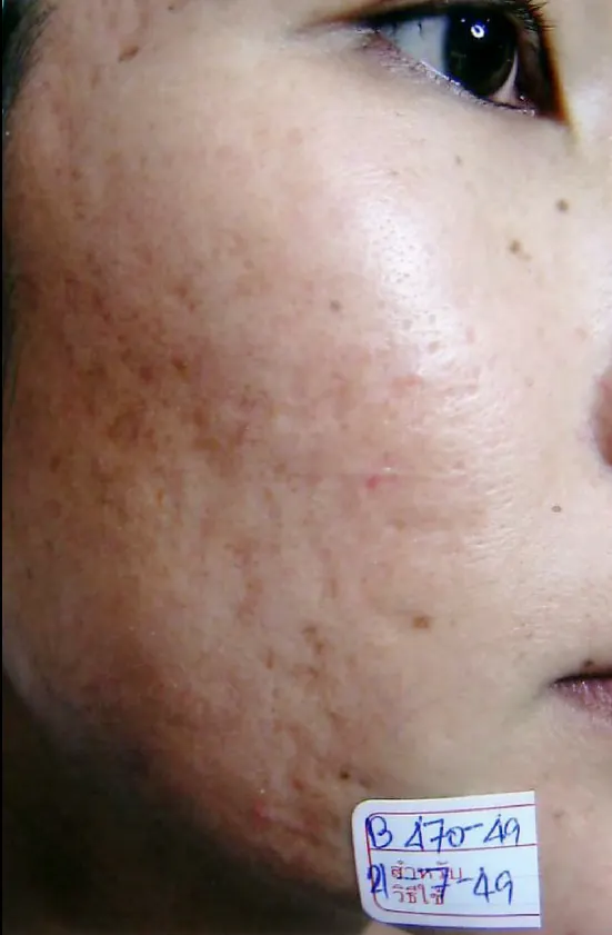 Restylane result 11, before treatment, Dulwich Natural Beauty London