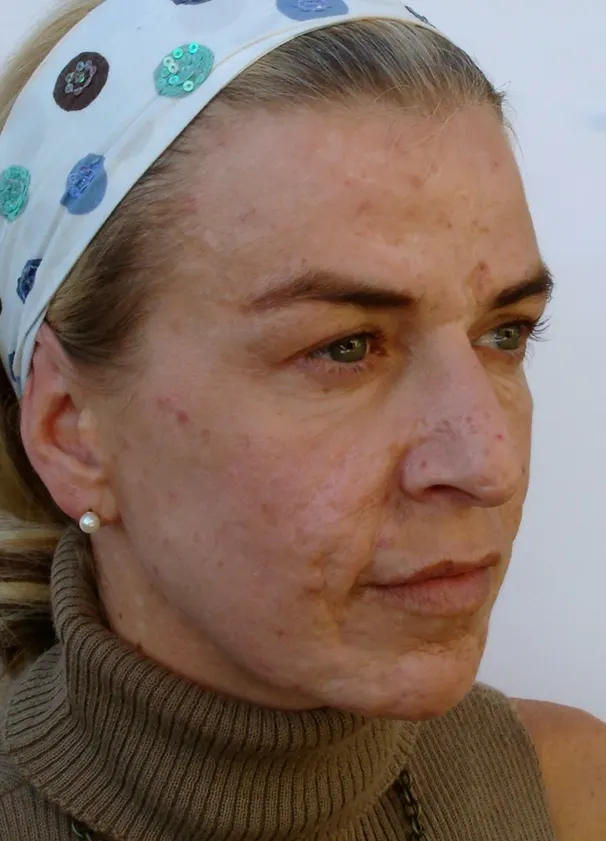 Restylane result 12, after treatment, Dulwich Natural Beauty London