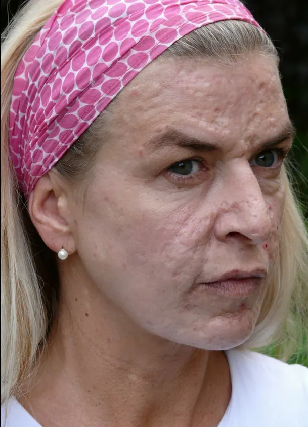 Restylane result 12, before treatment, Dulwich Natural Beauty London