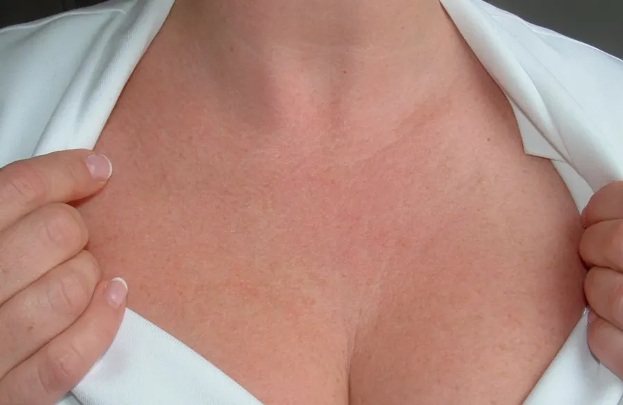 Restylane result 13, after treatment, Dulwich Natural Beauty London