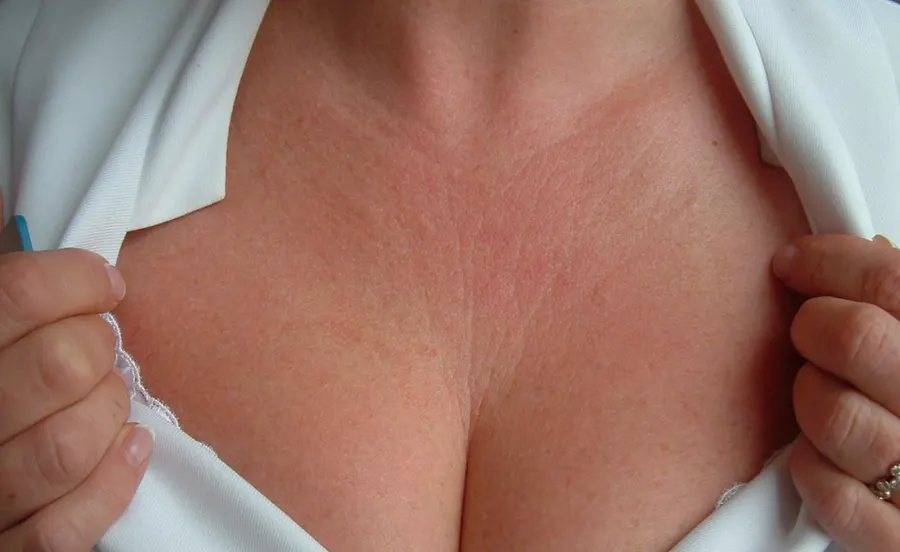 Restylane result 13, before treatment, Dulwich Natural Beauty London