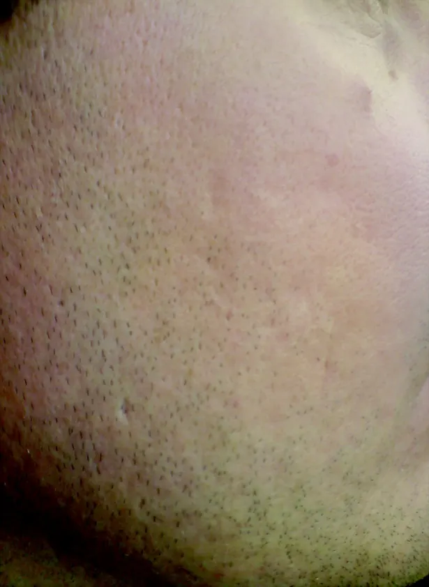 Restylane result 14, after treatment, Dulwich Natural Beauty London