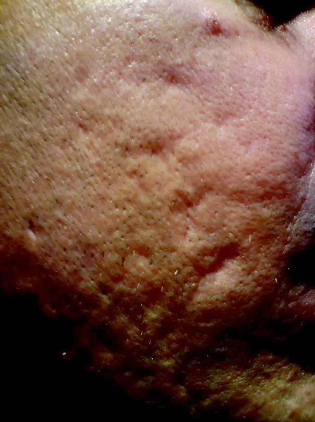 Restylane result 14, before treatment, Dulwich Natural Beauty London