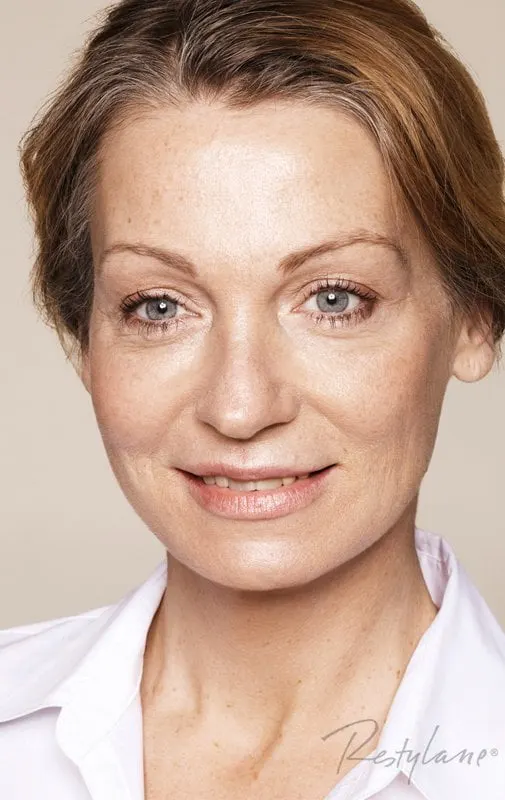 Restylane result 2, after treatment, Dulwich Natural Beauty London