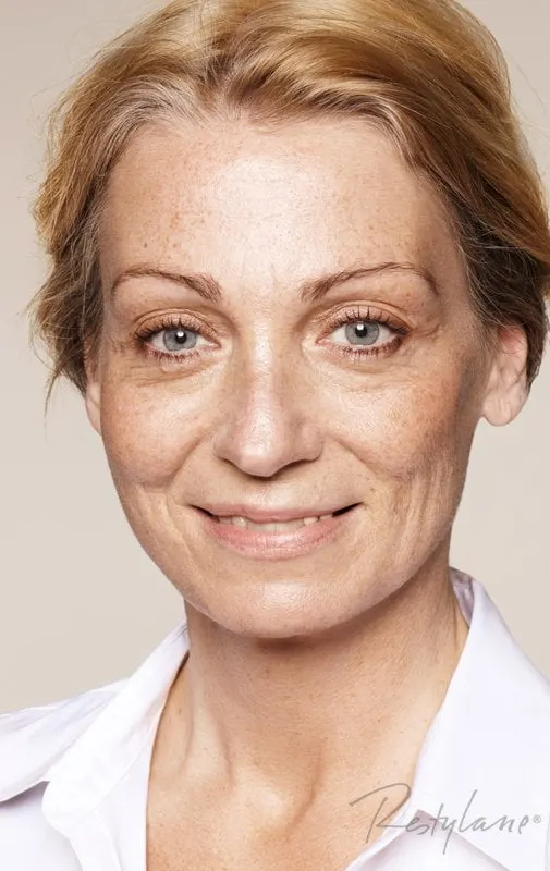 Restylane result 2, before treatment, Dulwich Natural Beauty London