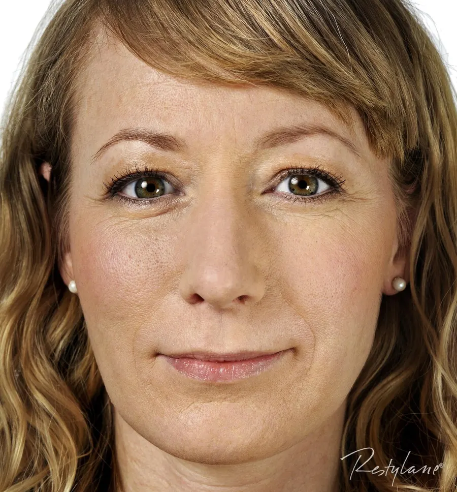 Restylane result 8, after treatment, Dulwich Natural Beauty London