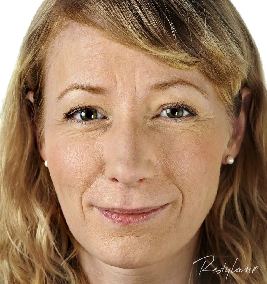 Restylane result 8, before treatment, Dulwich Natural Beauty London