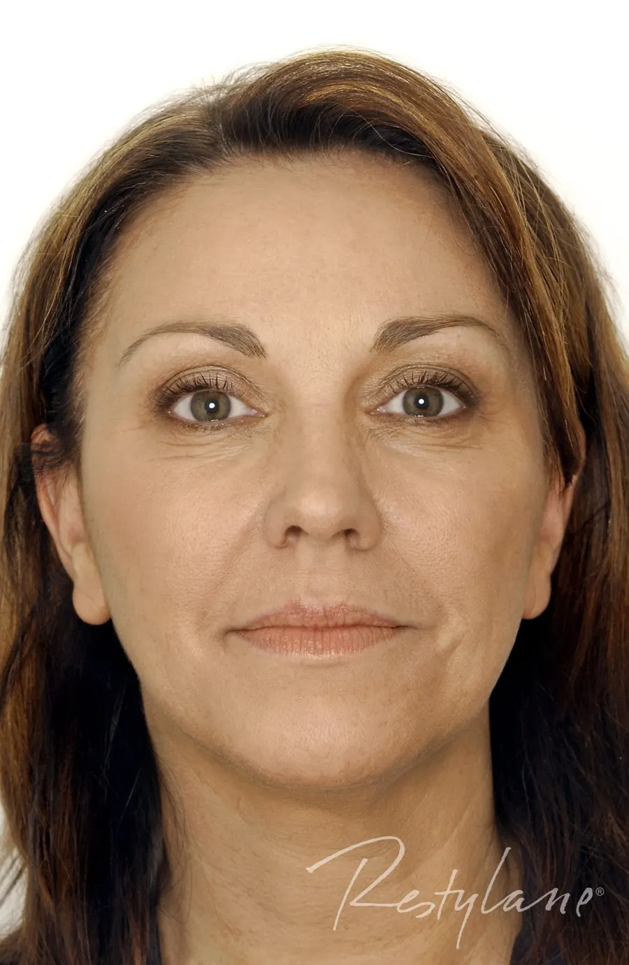 Restylane result 5, before treatment, Dulwich Natural Beauty London