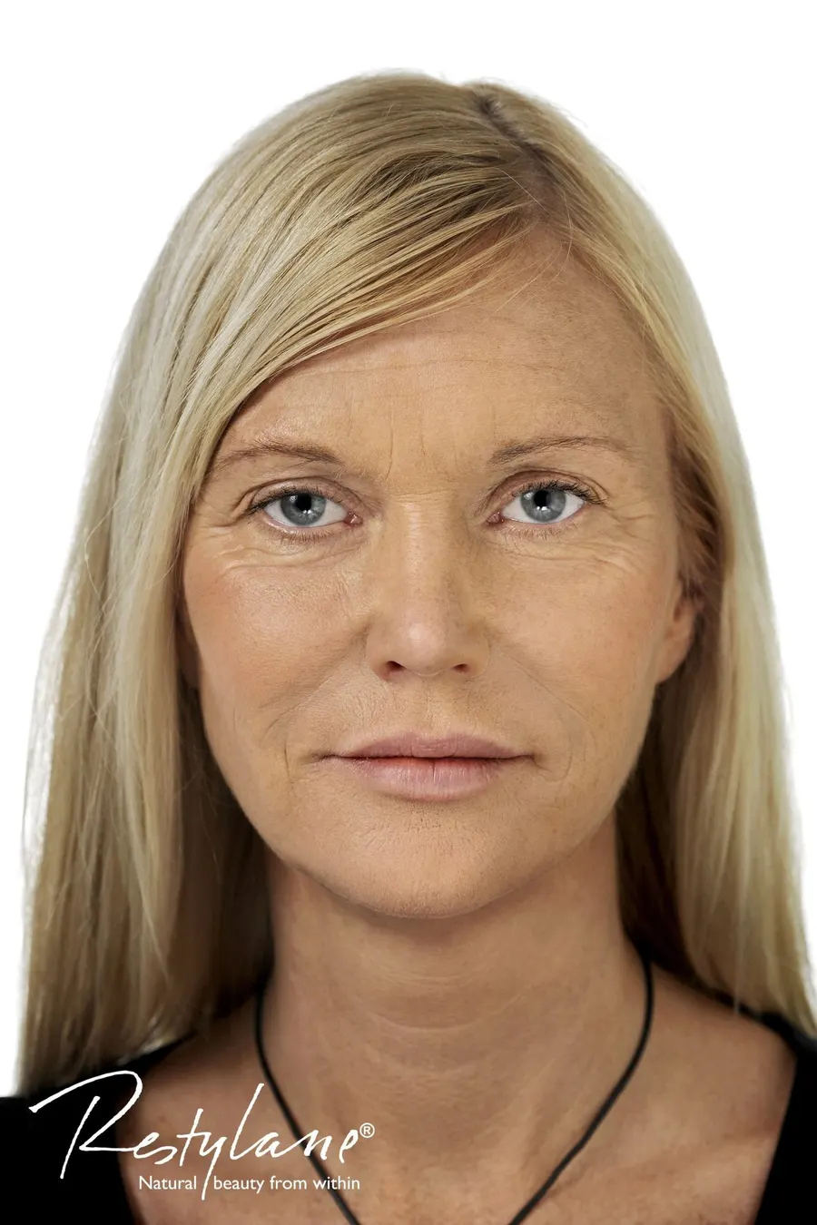 Restylane result 6, after treatment, Dulwich Natural Beauty London