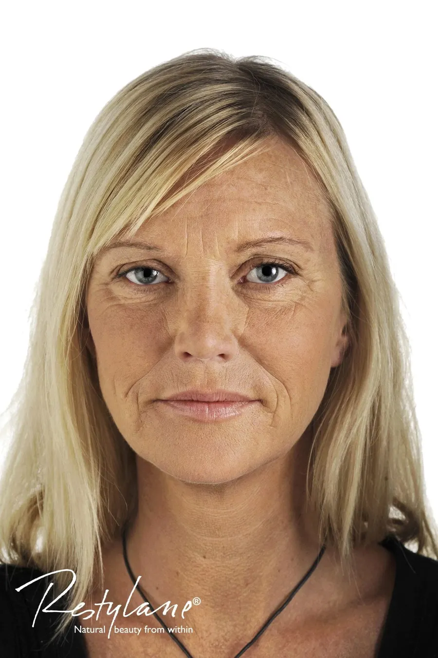 Restylane result 6, before treatment, Dulwich Natural Beauty London