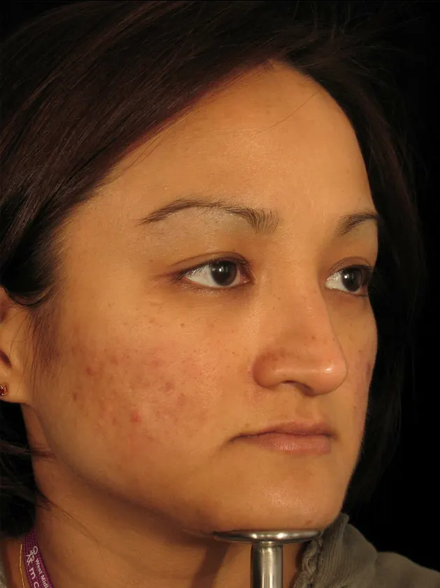 Restylane result 9, after treatment, Dulwich Natural Beauty London