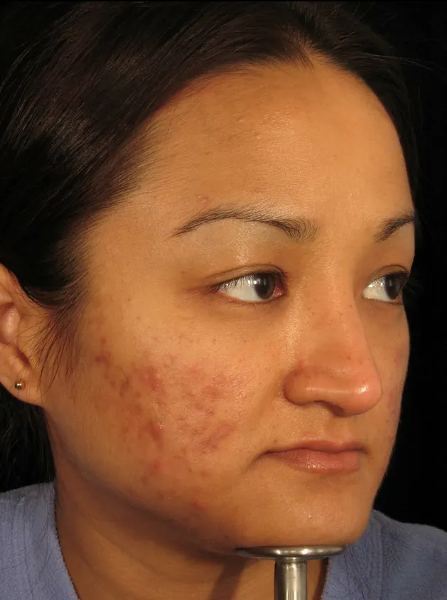 Restylane result 9, before treatment, Dulwich Natural Beauty London